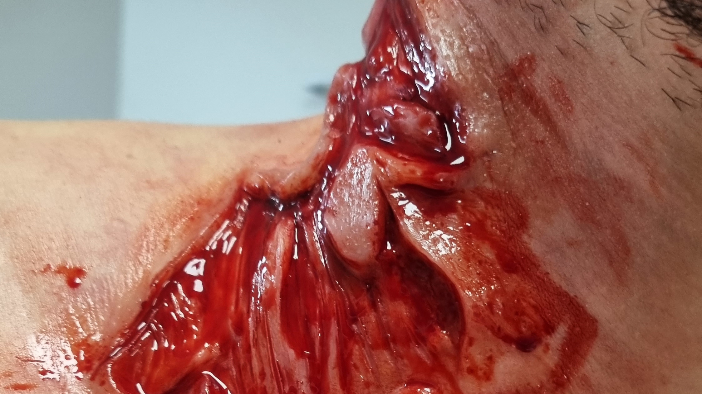 prosthetic_wound_16-9